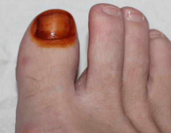 Onddo iodoaren tratamendua