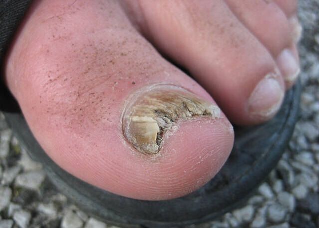 Utzikeriaren emaitza