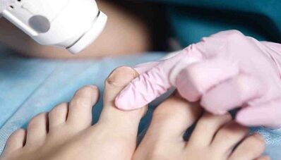 Hanketan onddoaren hardware tratamendua