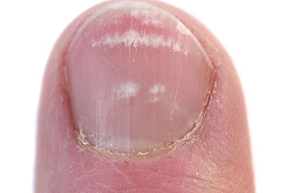 Lehen seinaleak eta sintomak