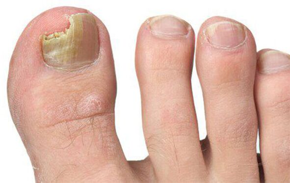 Onddoen hainbat forma