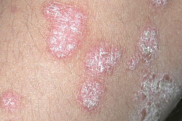 Onddoen infekzio batek eragindako psoriasia