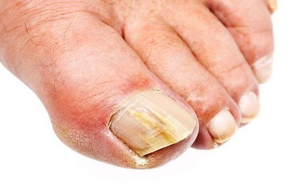 Onychomycosis - azazkalen onddoa
