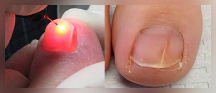 laser terapia